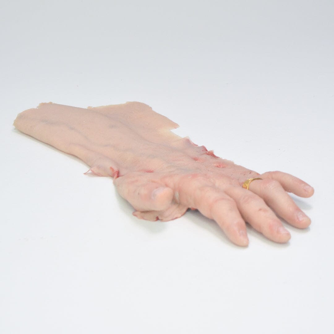 Degloved Hand Injury